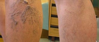 Варикозное расширение вен на ногах лечение